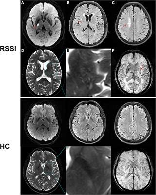 Frontiers Macular Microvasculature Is Associated With Total Cerebral