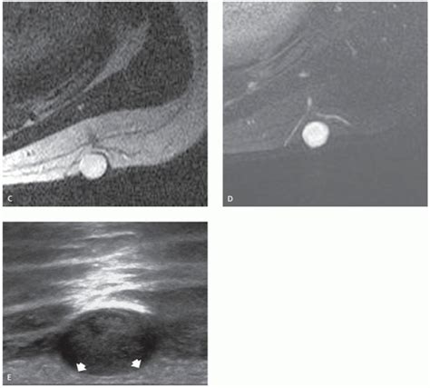 Superficial Soft Tissues Masses Radiology Key