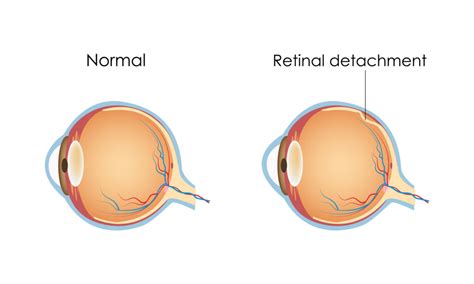 Retinal Detachment And Treatment Options Opticare Health