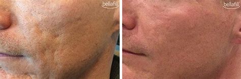 Bellafill Acne Scar Filler Irvine Acne Scar Treatment Orange County