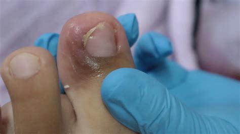 Ep438 Ingrown Nail Removal 👣 น้องมาจากชลบุรี พี่เอื้อมแนะนำคุณแม่วิธี