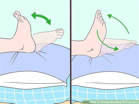 3 Ways To Reduce Swelling After Surgery Wikihow