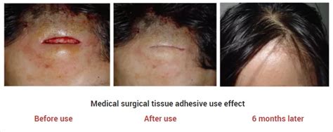 Perfectseal Ce Approved Topical Tissue Adhesive Skin Glue For Child - Buy Medical Surgical Glue ...