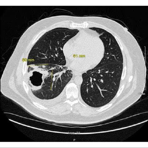 Computed Tomography Chest Day 1 Of Admission Of Note In The Right Download Scientific