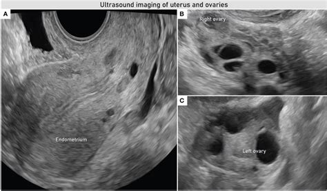 Transvaginal Ultrasound Evaluation Of Uterus And Adnexa Uniform