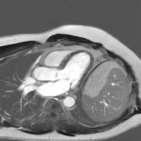 Delayed Cardiac Magnetic Resonance Image Obtained After Gd Download Scientific Diagram