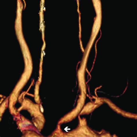 Cta Showed Occlusion Of The Right Internal Carotid Artery And Stenosis Download Scientific