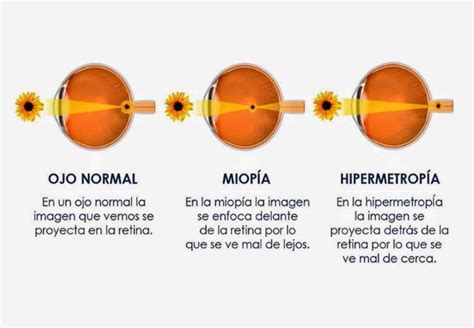 Diferencia entre Hipermetropía y Miopía Área Oftalmológica Avanzada