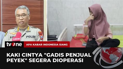 Cintya Gadis Penjual Peyek Akan Segera Menjalani Operasi Otot Kaki