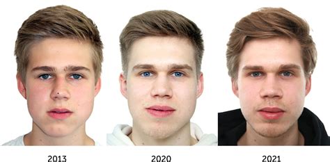 Asymmetrical Face Surgery Before And After