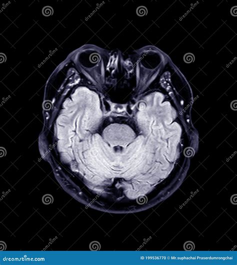 Mri Of The Brain Axial T2 Flair Stock Illustration Illustration Of