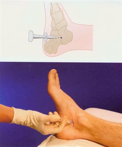 Subtalar Joint Injection Nursing