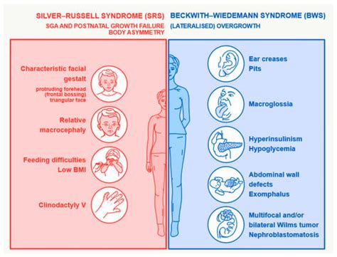 Beckwith Wiedemann Syndrome Genetics