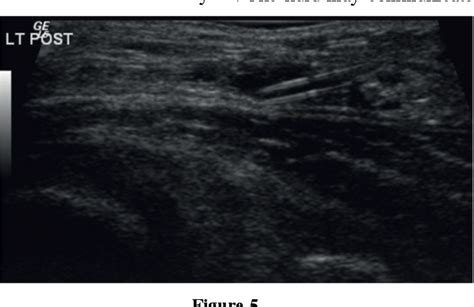 Figure From Management Of Symptomatic Bakers Cysts With Ultrasound