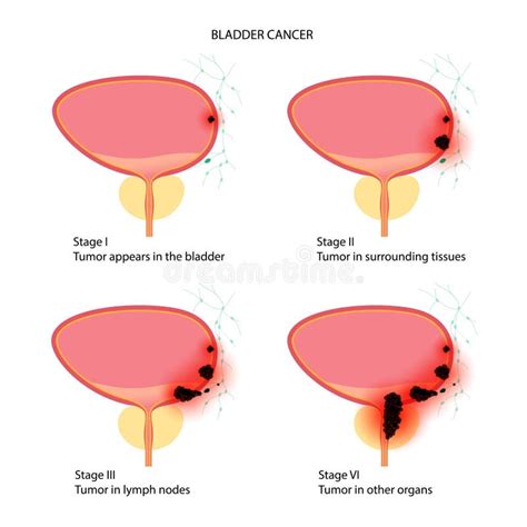 Prostate Cancer Infographic Stock Illustrations 653 Prostate Cancer