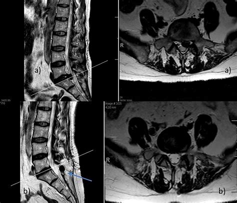 Lumbar Disc Herniation Surgery With Microdiscectomy Plus Interspinous