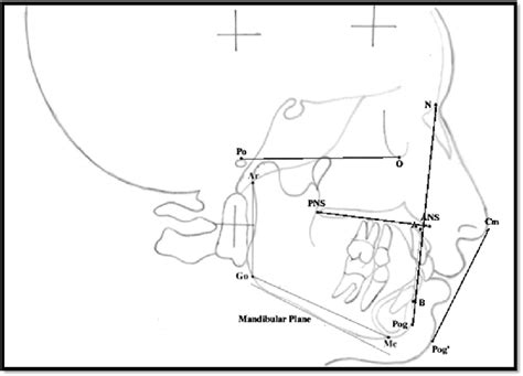 E Showing Cephalometric Hard And Soft Tissue Planes Download