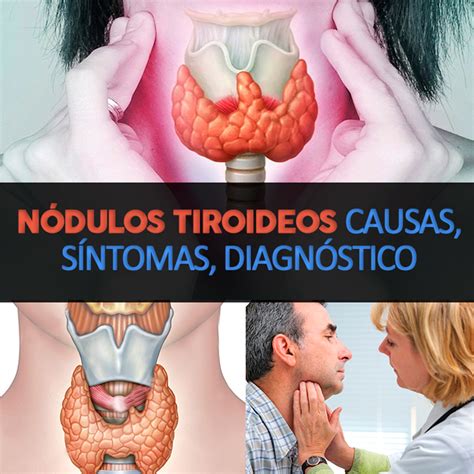 Nódulos Tiroideos Causas Síntomas Diagnóstico Y Tratamiento La