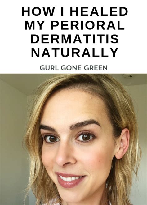 How I Was Able To Heal My Perioral Dermatitis Naturally Artofit