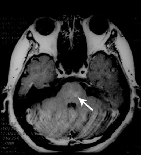 Unruptured capillary telangiectasia of the brain stem. Axial T1 weigted ...