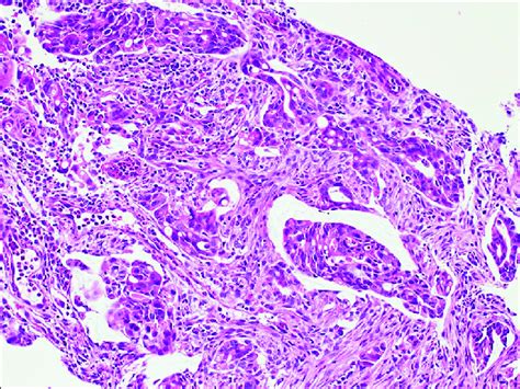 Gastric Biopsy Revealed A Moderately To Poorly Differentiated Invasive Download Scientific