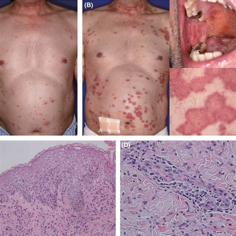 Clinical And Histopathological Features Of The Rash A Clinical Image