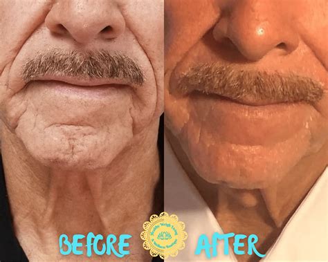 Infrared Thermal Facelift Anti Aging Treatment The Villages Fl