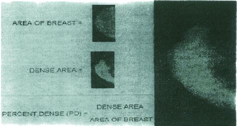 Quantitative Assessment Of Breast Density Download Scientific Diagram