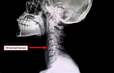 Broken Vertebrae X Ray