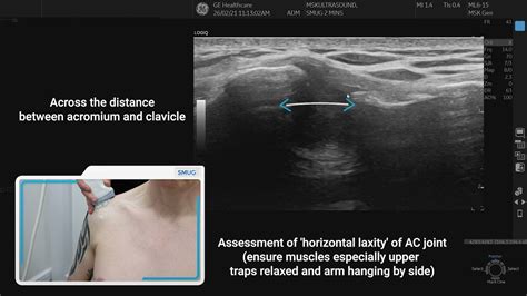 Acromioclavicular Joint 2 Min Series Mskus Youtube