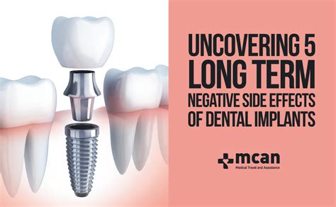 Uncovering Long Term Negative Side Effects Of Dental Implants Mcan