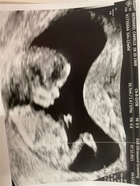 12 Weeks Scan Gender Guess June 2022 Babies Forums What To Expect