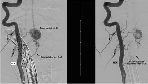 Preoperative Angiography Showing Successful Partly Embolization Left