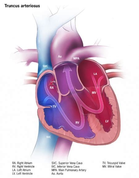 Truncus Arteriosus Wikem