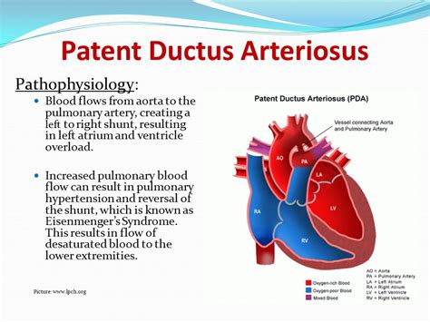 Patent Ductus Arteriosus Pathophysiology