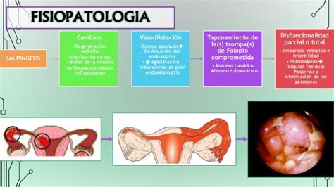 Enfermedad Pelvica Inflamatoria