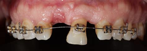 Pre Surgical Orthodontic Extrusion Of Compromised Teeth