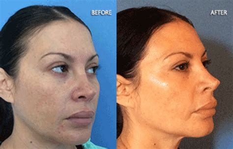 Stem Cell Microneedling Rf — Neoderma Advanced Skin Care