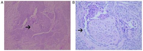 Perineural Invasion As A Prognostic Risk Factor In Patients With Early