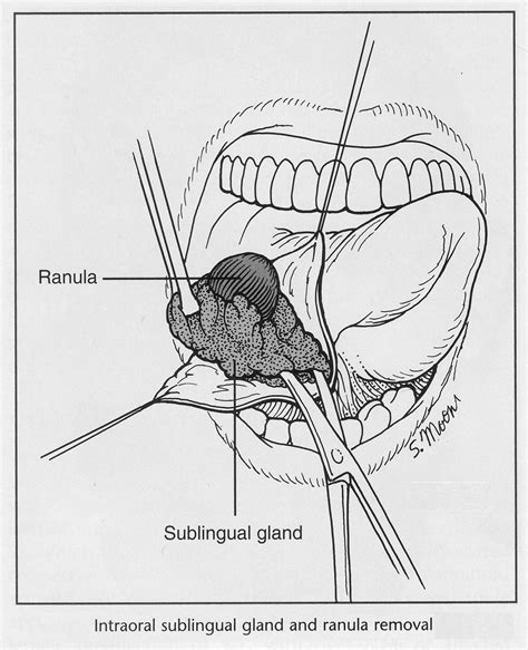 Sublingual Gland Removal Exodontia