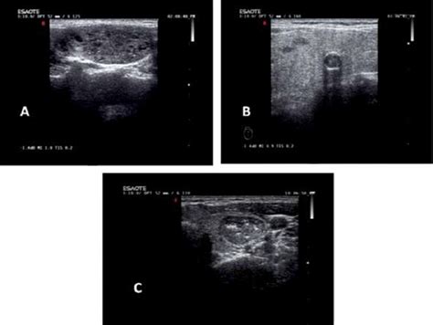 Thyroid nodule calcifications detected in ultrasonography. (A)... | Download Scientific Diagram