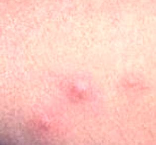 Chiggers Rash Pictures, Treatment, Causes, Symptoms