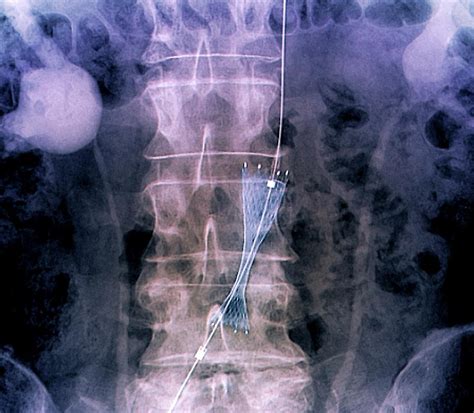 Implantation Of Stent In Aorta Photograph By Zephyr Science Photo