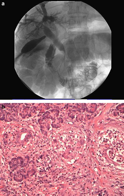 Cholangiogram Showing Distal Common Bile Duct Cbd Stricture B High