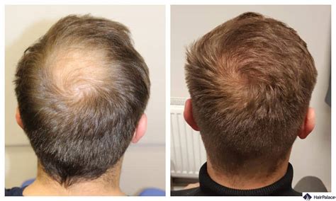 Hair Transplant Turkey Best Clinics And Prices 2025