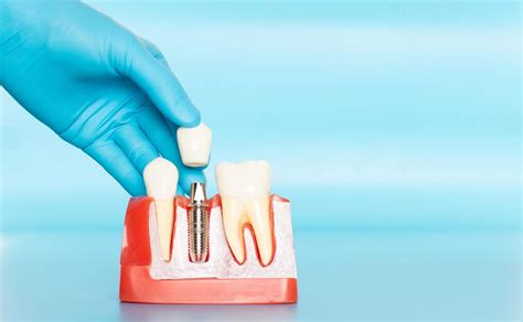 Tipos de Implantes Dentários veja os principais e como funcionam