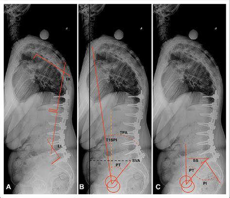 Parameters Of Sagittal Spinopelvic Alignment Including A Lumbar Download Scientific Diagram