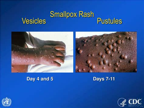 Ppt Evaluating Patients With Acute Generalized Vesicular Or Pustular Rash Illnesses Powerpoint