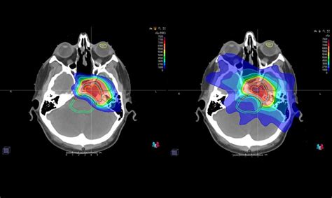 Proton Therapy For Brain Tumors Johns Hopkins Medicine