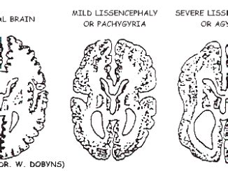 Pachygyria – Mild Lissencephaly – Making Connections. Finding Solutions.